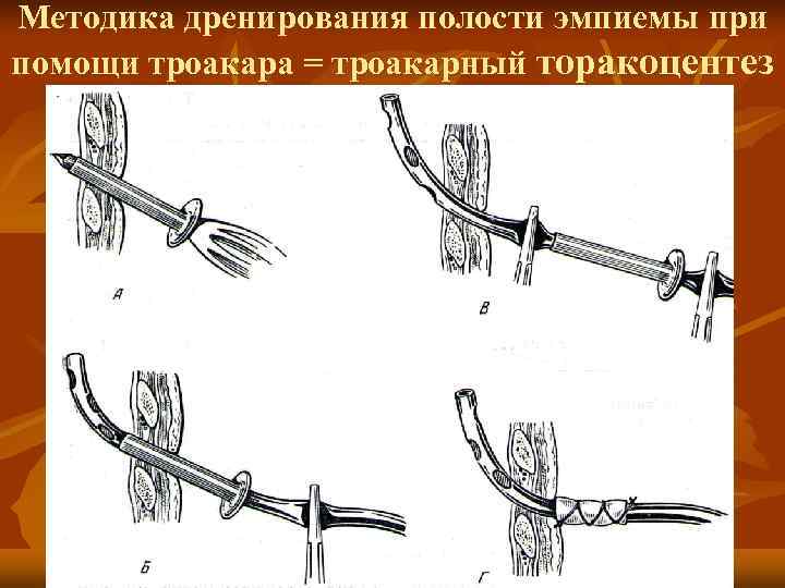 Троакарная цистостомия фото