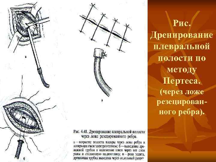   Рис. Дренирование плевральной полости по  методу  Пертеса.  (через ложе