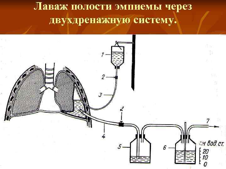 Дренирования полостей. Аппарат Боброва для дренирования плевральной полости. Метод Субботина дренирование. Активная аспирация вакуумное дренирование. Схема дренирования плевральной полости.