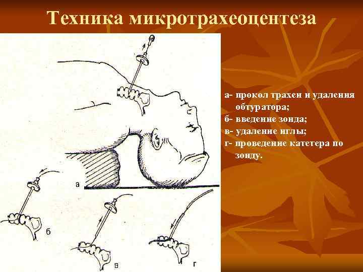 Техника микротрахеоцентеза    а- прокол трахеи и удаления    