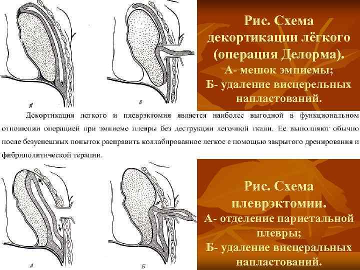 Плеврэктомия