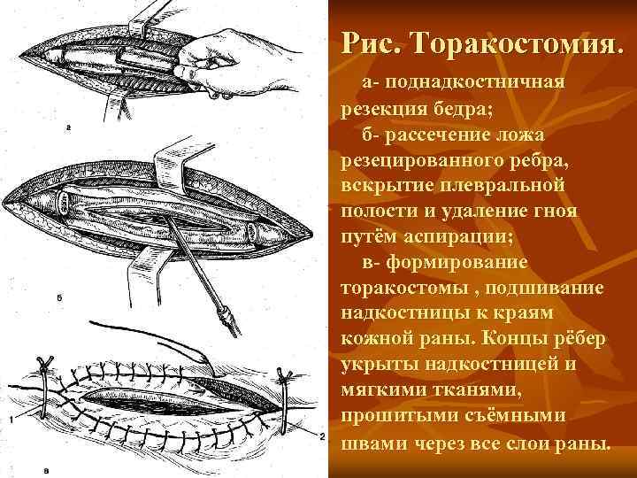 Рис. Торакостомия.  а- поднадкостничная резекция бедра;  б- рассечение ложа резецированного ребра, вскрытие
