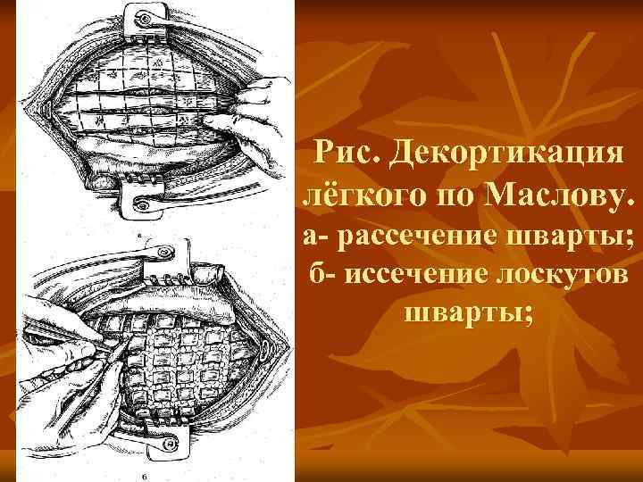 Плеврэктомия. Операция декортикация легкого. Плеврэктомия с декортикацией легкого. Декортикация легкого при эмпиеме. Декортикация легкого техника.