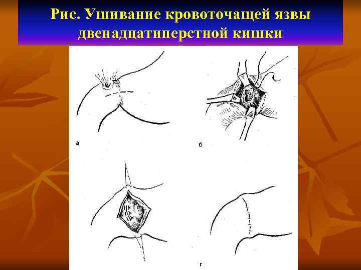 Рис. Ушивание кровоточащей язвы двенадцатиперстной кишки 