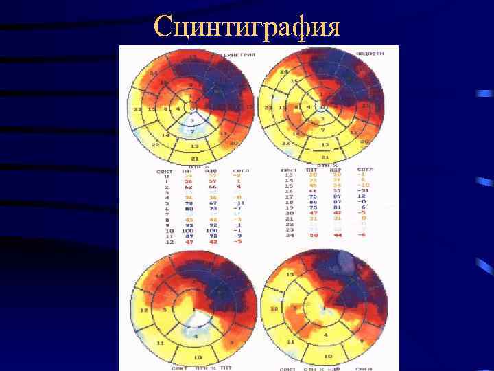 Сцинтиграфия 