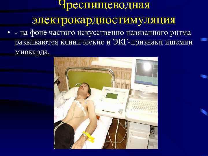    Чреспищеводная  электрокардиостимуляция • - на фоне частого искусственно навязанного ритма