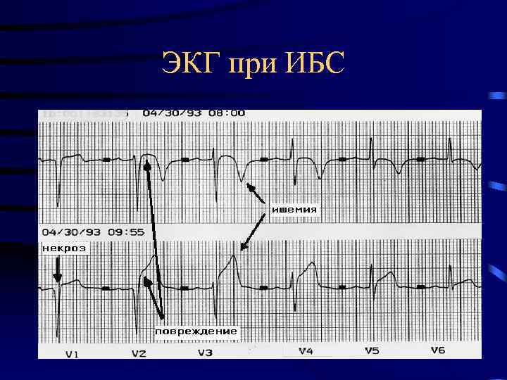 ЭКГ при ИБС 