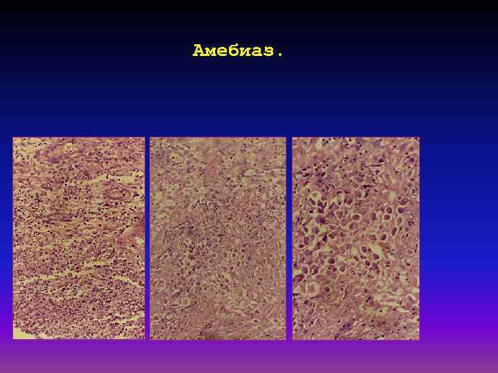 Амебиаз. 