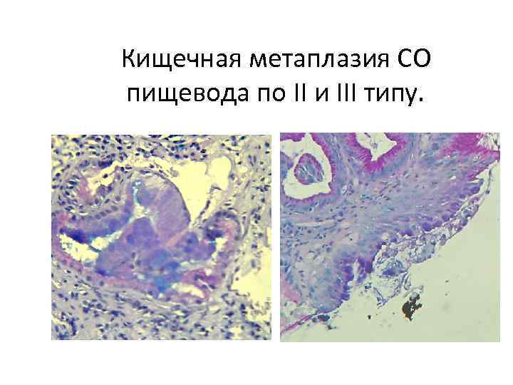 Кишечная метаплазия желудка. Тонкокишечная метаплазия гистология. Кишечная метаплазия желудка на ФГДС. Кишечная метаплазия пищевода. Тонкокишечная метаплазия пищевода.