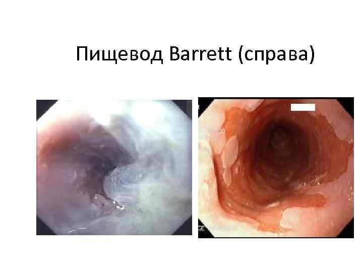 Пищевод Barrett (справа) 
