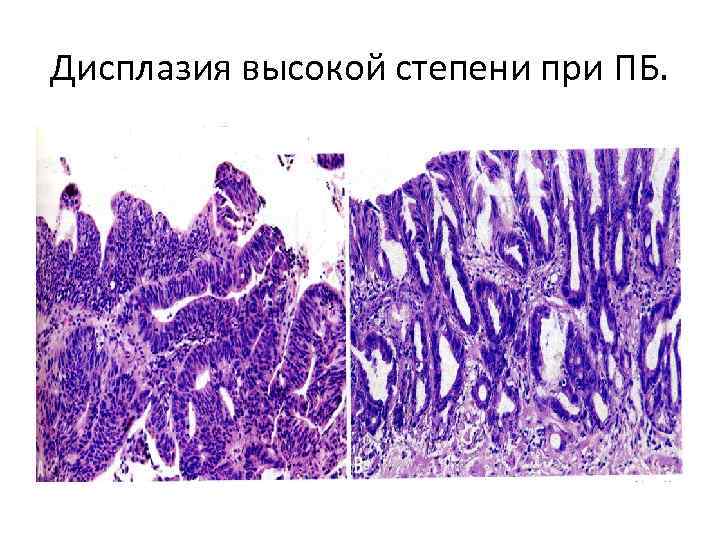 Дисплазия высокой степени при ПБ. 