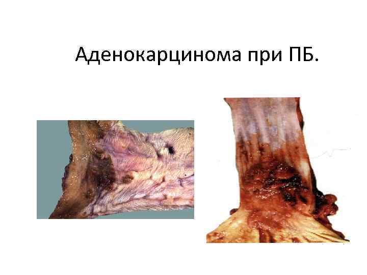 Аденокарцинома при ПБ. 