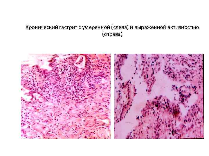 Хронический гастрит с умеренной (слева) и выраженной активностью     (справа) 