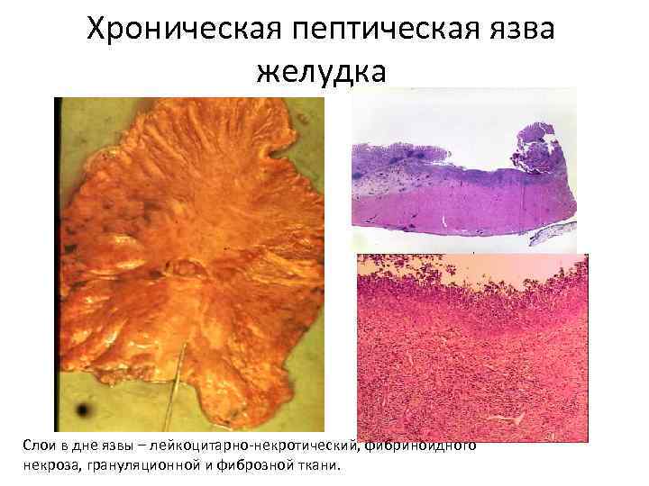   Хроническая пептическая язва    желудка Слои в дне язвы –