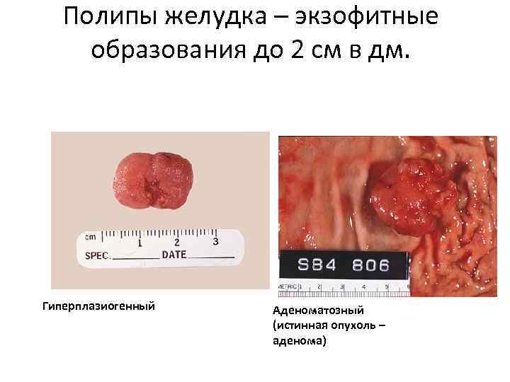  Полипы желудка – экзофитные образования до 2 см в дм. Гиперплазиогенный  Аденоматозный