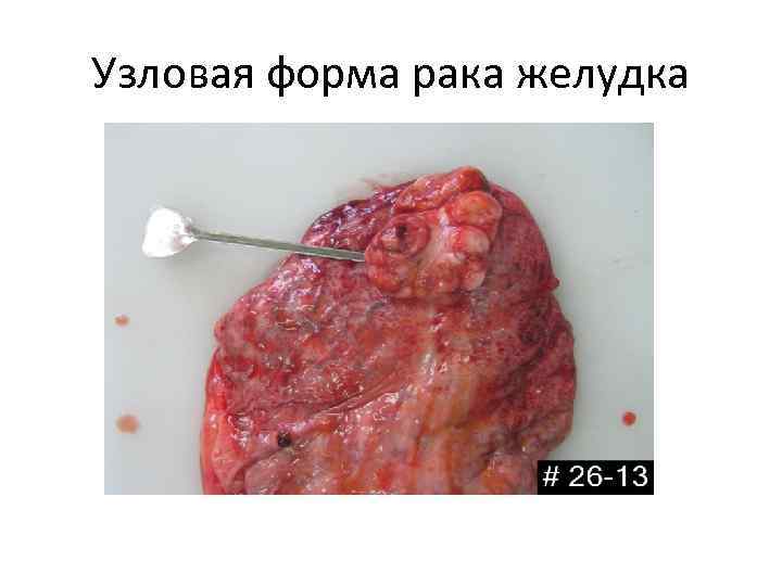 Узловая форма рака желудка 