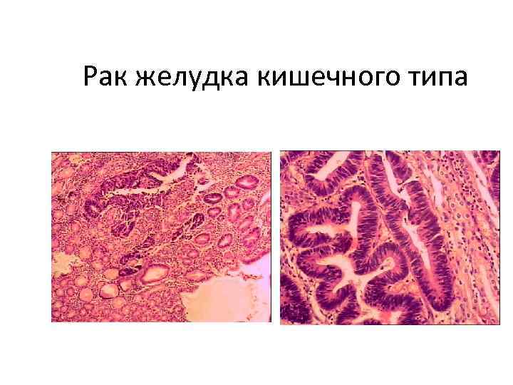 Рак желудка кишечного типа 