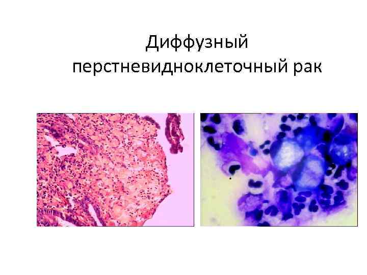   Диффузный перстневидноклеточный рак 