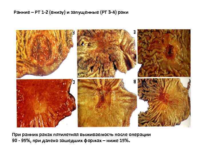 Ранние – РТ 1 -2 (внизу) и запущенные (РТ 3 -4) раки При ранних