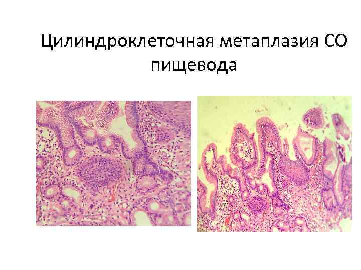 Цилиндроклеточная метаплазия СО  пищевода 