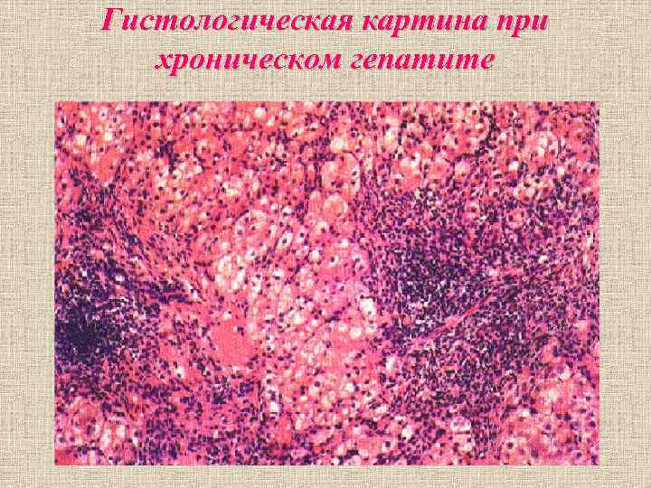 Гистологическая картина при хроническом гепатите Гистологическая картина при хроническом гепатите
