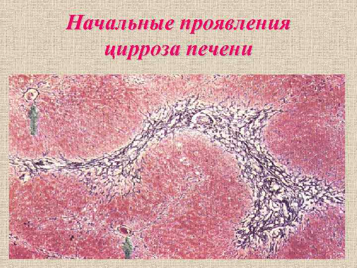 Начальные проявления цирроза печени Начальные проявления цирроза печени