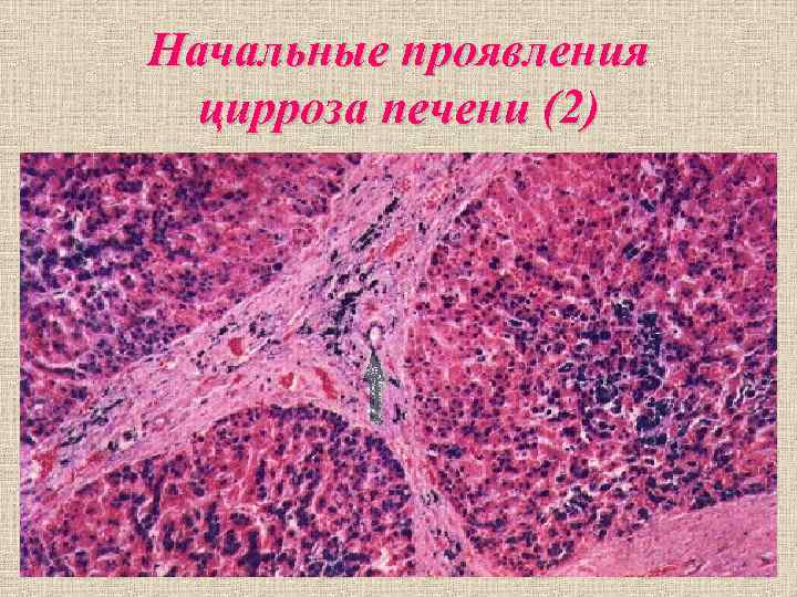 Начальные проявления цирроза печени (2) Начальные проявления цирроза печени (2)
