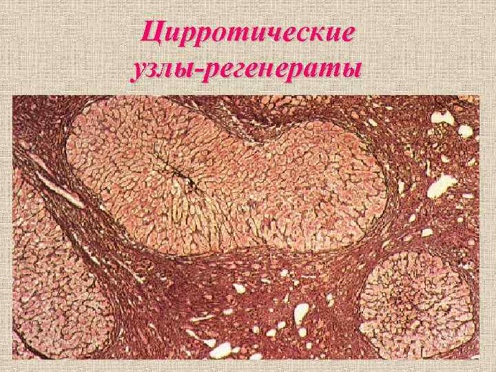 Цирротические узлы-регенераты Цирротические узлы-регенераты
