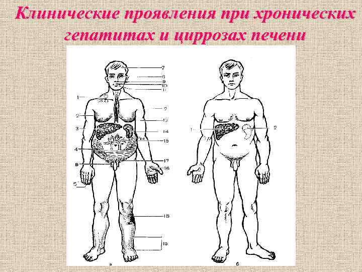 Клинические проявления при хронических гепатитах и циррозах печени Клинические проявления при хронических гепатитах и циррозах печени