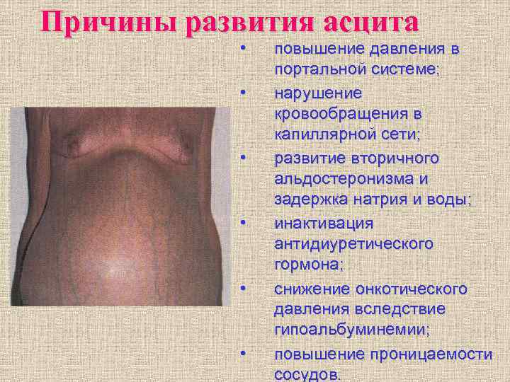 Причины развития асцита • повышение давления в портальной системе; Причины развития асцита • повышение давления в портальной системе;