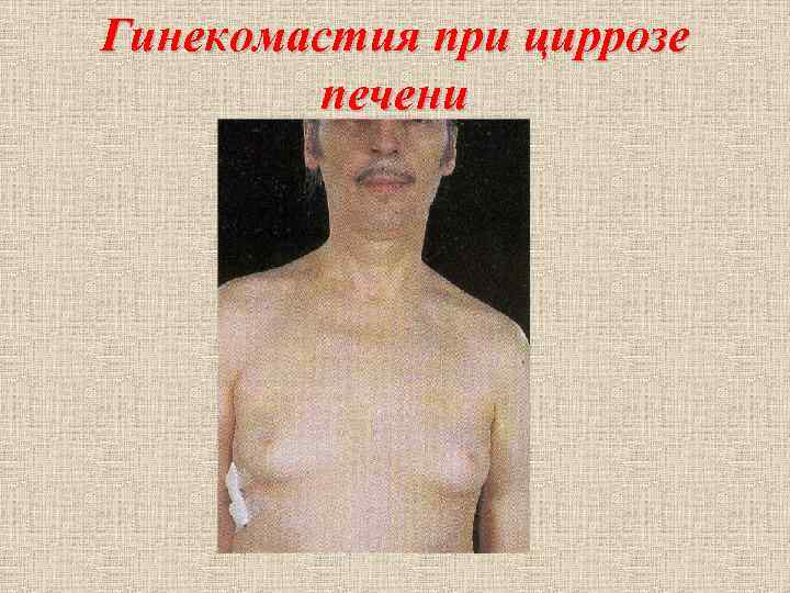 Гинекомастия при циррозе печени Гинекомастия при циррозе печени