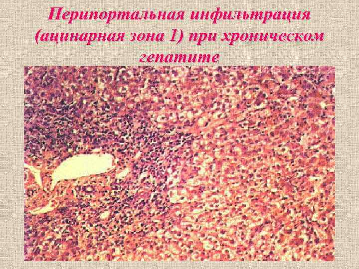 Перипортальная инфильтрация (ацинарная зона 1) при хроническом гепатите Перипортальная инфильтрация (ацинарная зона 1) при хроническом гепатите