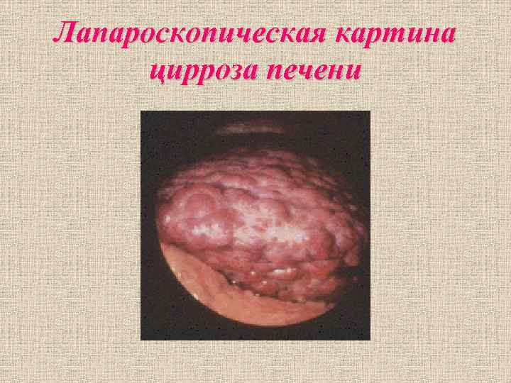 Лапароскопическая картина цирроза печени Лапароскопическая картина цирроза печени