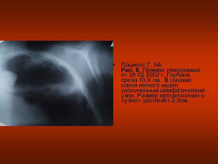 • Пациент Г. 54 г  Рис. 8. Прямая томограмма  от 26.