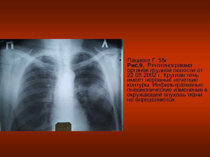  • Пациент Г. 55 г  Рис. 9. Рентгенограмма  органов грудной полости