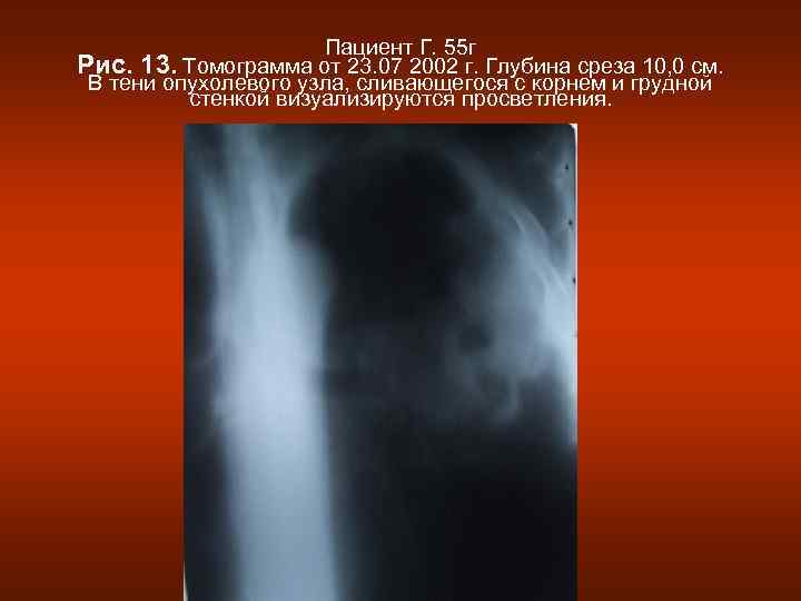      Пациент Г. 55 г Рис. 13. Томограмма от 23.
