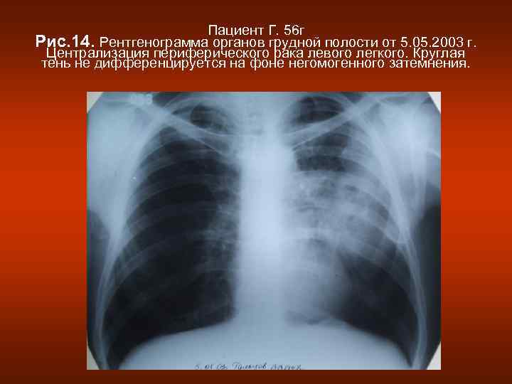      Пациент Г. 56 г Рис. 14. Рентгенограмма органов грудной