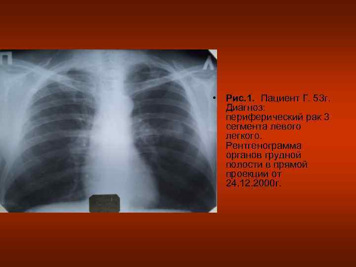 • Рис. 1. Пациент Г. 53 г.  Диагноз:  периферический рак 3