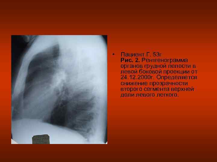  • Пациент Г. 53 г  Рис. 2. Рентгенограмма  органов грудной полости