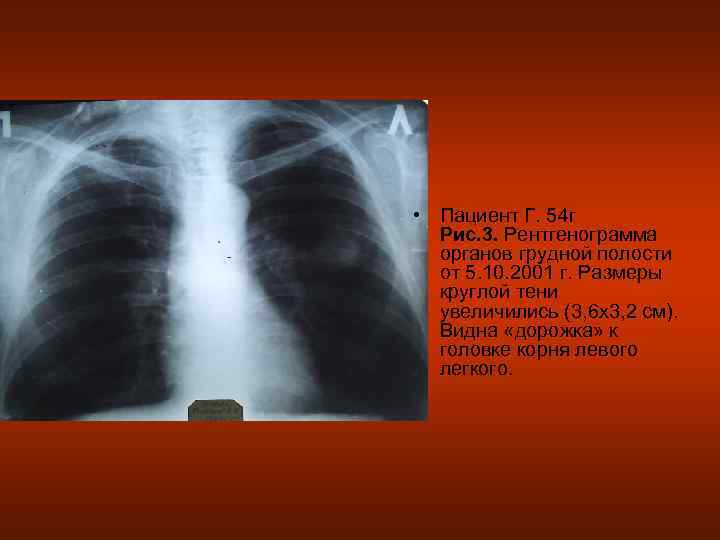  • Пациент Г. 54 г  Рис. 3. Рентгенограмма  органов грудной полости