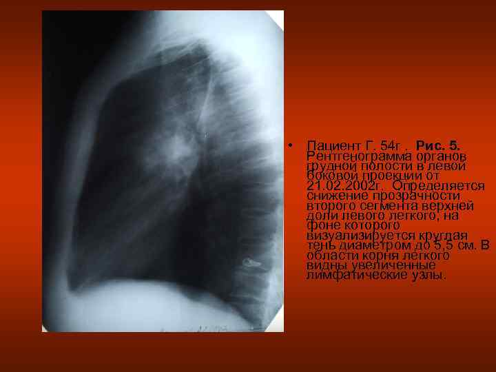  • Пациент Г. 54 г. Рис. 5.  Рентгенограмма органов  грудной полости