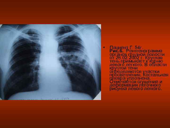  • Пациент Г. 54 г.  Рис. 6. Рентгенограмма  органов грудной полости