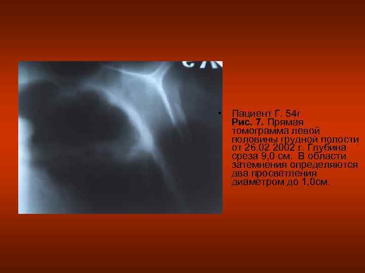  • Пациент Г. 54 г  Рис. 7. Прямая  томограмма левой 