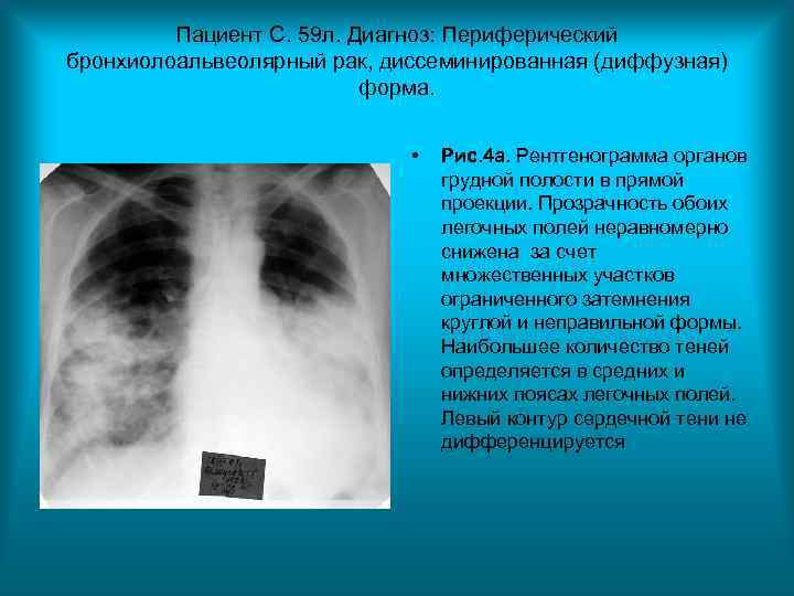 Пациент С. 59 л. Диагноз: Периферический бронхиолоальвеолярный рак, диссеминированная (диффузная) Пациент С. 59 л. Диагноз: Периферический бронхиолоальвеолярный рак, диссеминированная (диффузная)