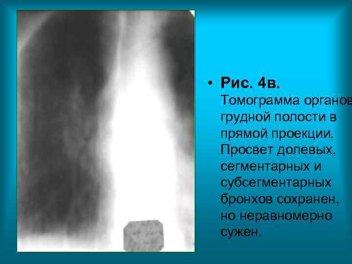 • Рис. 4 в. Томограмма органов грудной полости в прямой проекции. • Рис. 4 в. Томограмма органов грудной полости в прямой проекции.