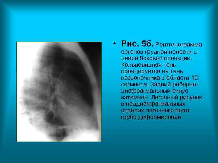 • Рис. 5 б. Рентгенограмма органов грудной полости в левой боковой • Рис. 5 б. Рентгенограмма органов грудной полости в левой боковой