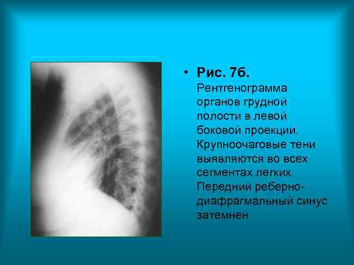 • Рис. 7 б. Рентгенограмма органов грудной полости в левой • Рис. 7 б. Рентгенограмма органов грудной полости в левой