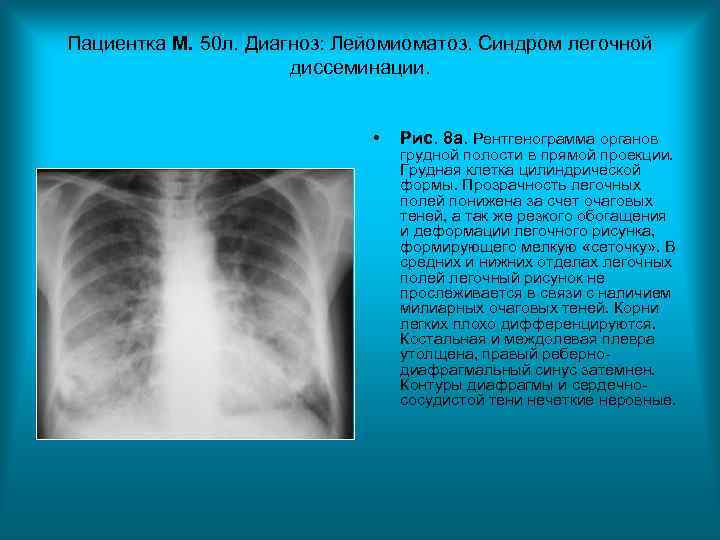 Пациентка М. 50 л. Диагноз: Лейомиоматоз. Синдром легочной диссеминации. Пациентка М. 50 л. Диагноз: Лейомиоматоз. Синдром легочной диссеминации.