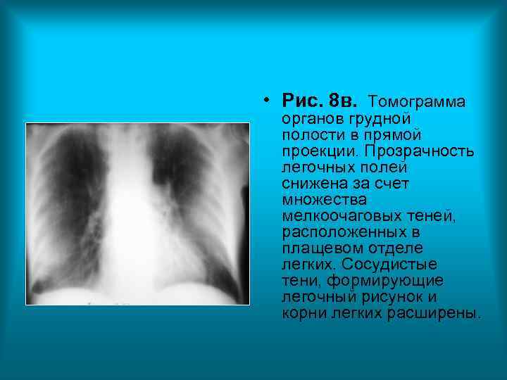 • Рис. 8 в. Томограмма органов грудной полости в прямой проекции. Прозрачность легочных • Рис. 8 в. Томограмма органов грудной полости в прямой проекции. Прозрачность легочных