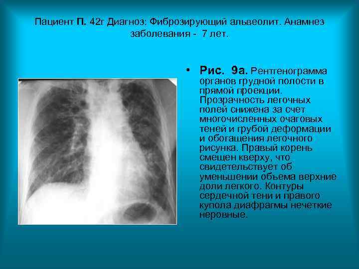 Пациент П. 42 г Диагноз: Фиброзирующий альвеолит. Анамнез заболевания - 7 Пациент П. 42 г Диагноз: Фиброзирующий альвеолит. Анамнез заболевания - 7